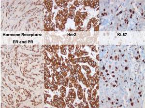 Breast Lesions, Resources, Dept. of Laboratory Medicine & Pathology