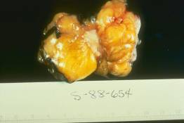 BR 9 - Invasive carcinoma resected in a 