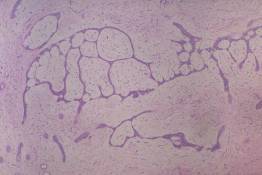 BR 7 - Fibroadenoma (microscopic)