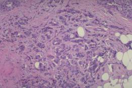 BR17 - Infiltrating duct carcinoma