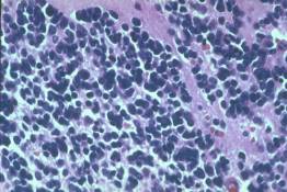 PP 12 - High magnification of an undifferentiated neuroblastoma