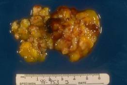 PP 13 - Botryoid rhabdomyosarcoma arising in the bile duct