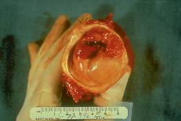 FR 1 Invasive Cervical Carcinoma