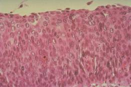 FR 3 Cervix: Cervical Intraepithelial Neoplasia (CIN III)