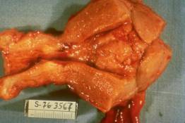 FR 4 Uterus with Endometrial Carcinoma