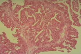 FR 7 Ovarian Carcinoma: Papillary Serous Variant