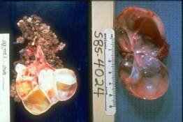FR 12 Ovarian cysts, benign and malignant
