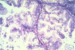 FR 13 Ovarian Carcinoma: Mucinous Variant
