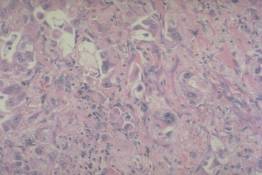 RS 45 Poorly differentiated adenocarcinoma