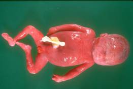PP 4 Hydropic fetus