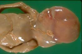 PP 6 Cystic hygroma (20 week intrauterine demise)