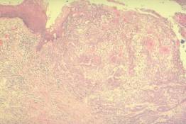 RS 28 Invasive squamous cell (epidermoid) carcinoma