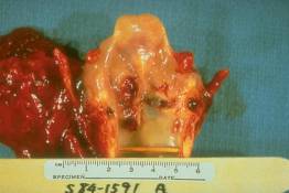 RS 33 Carcinoma of the larynx