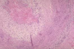 V 1	Giant Cell (Temporal) Arteritis