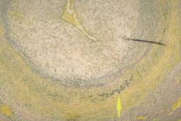 V 2	Giant Cell (Temporal) Arteritis-Elastic Tissue Stain