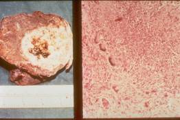 V 4	Wegener's Granulomatosis